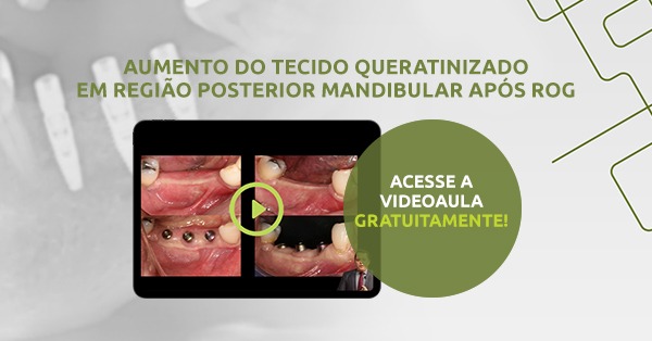 MEMBRANAS REABSORVÍVEIS OU NÃO: SAIBA QUANDO CADA UMA DELAS É INDICADA