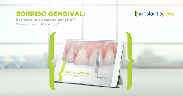 Sorriso gengival: Sorriso alto ou sorriso gengival? Você sabe a diferença?